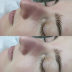 Before and after blackhead remover vacuum showing clear pores on nose