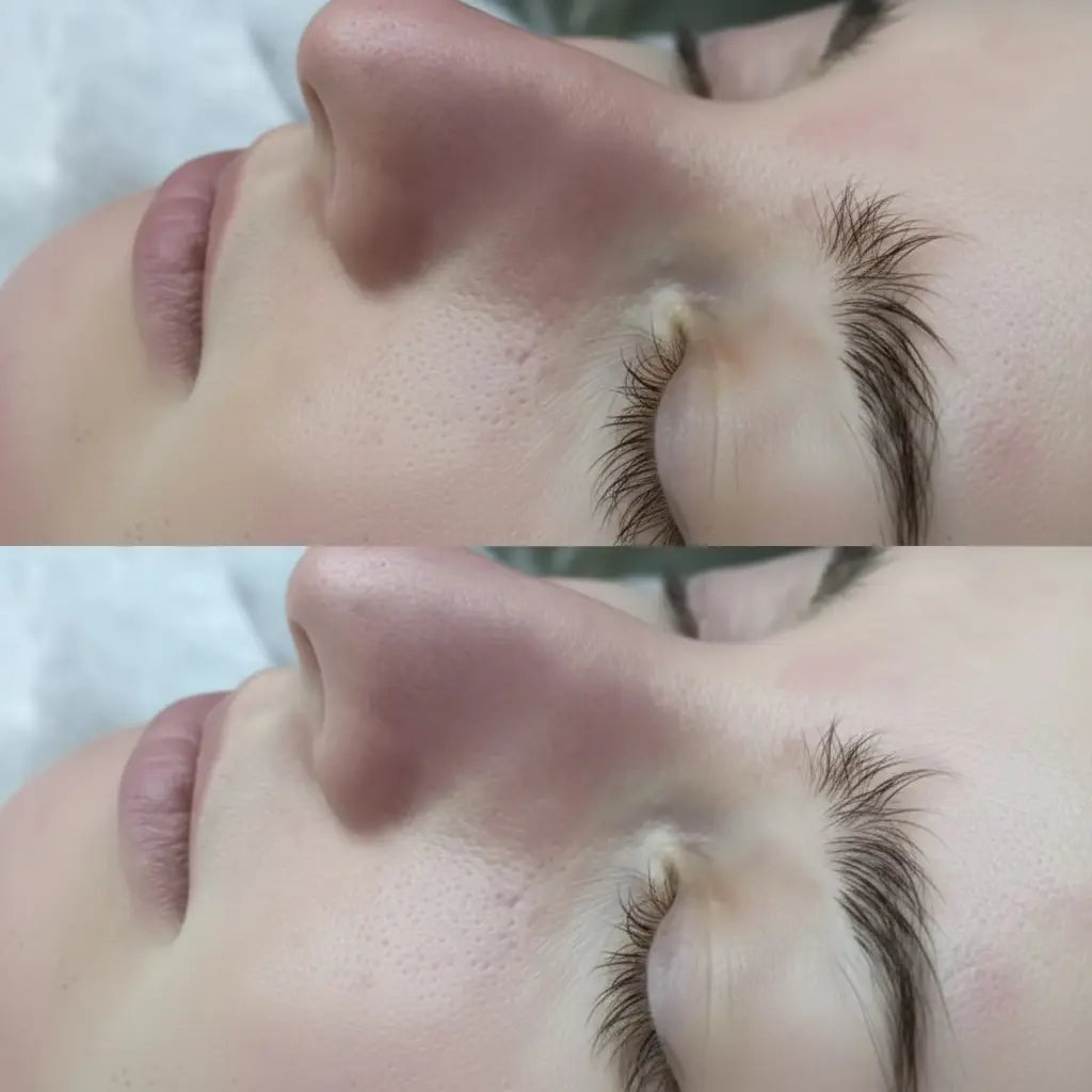 Before and after blackhead remover vacuum showing clear pores on nose